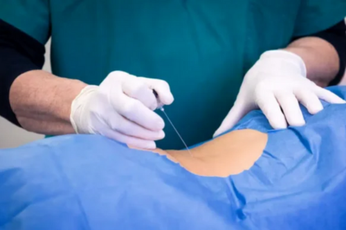 Spinal Injections
